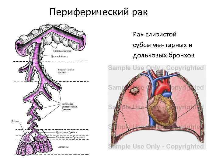 Как выглядит периферический рак легкого на компьютерной томографии