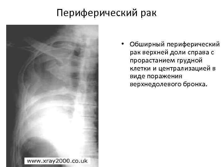 Периферический рак нижней доли