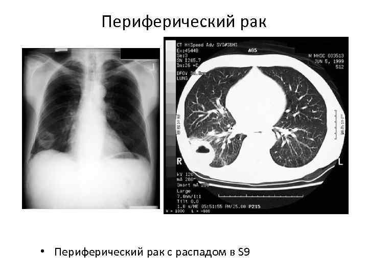 Периферический рак • Периферический рак с распадом в S 9 