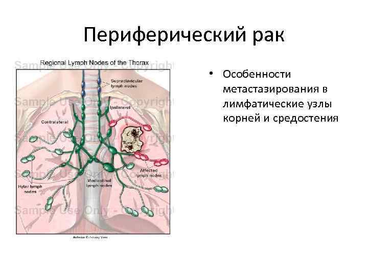 Лимфоузлы в легких причины. Схема внутригрудных лимфоузлов. Средостенные лимфатические узлы расположение. Медиастинальные лимфатические узлы увеличены. Лимфатические узлы средостения схема.