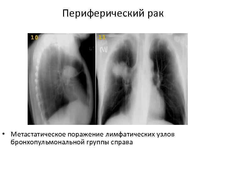 Как выглядит периферический рак легкого на компьютерной томографии