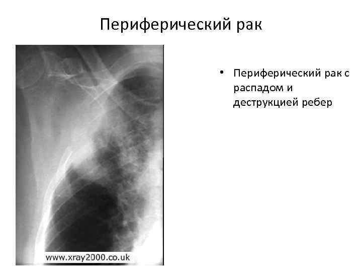 Периферический рак • Периферический рак с распадом и деструкцией ребер 