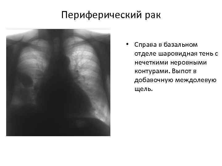 Периферический рак • Справа в базальном отделе шаровидная тень с нечеткими неровными контурами. Выпот