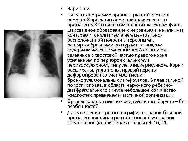 Легочный рисунок усилен за счет перибронхиального компонента