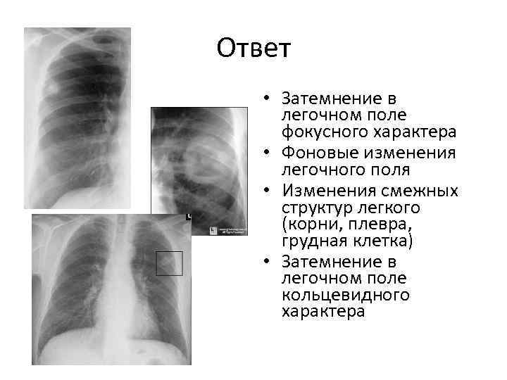 Ответ • Затемнение в легочном поле фокусного характера • Фоновые изменения легочного поля •