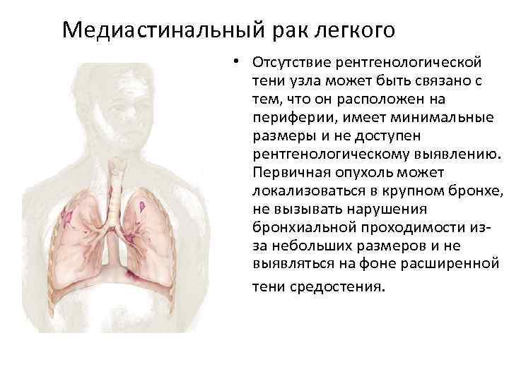 Медиастинальный рак легкого • Отсутствие рентгенологической тени узла может быть связано с тем, что