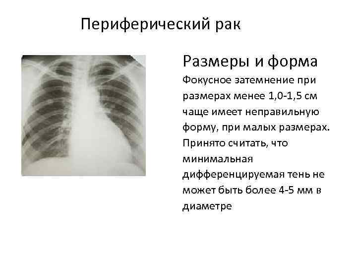 Рак легкого 5 см. Фокусные затемнения в легких. Затемнение на рентгенограмме характерно для:. Потемнение в легких при онкологии.