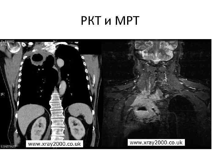 РКТ и МРТ 
