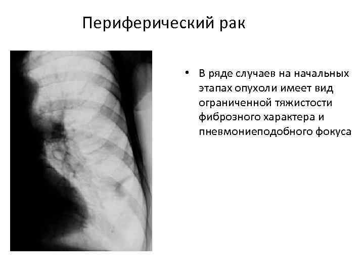 Диагноз периферический рак. Пневмониеподобная форма бар кт.