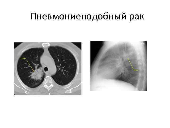 Диагноз периферический рак