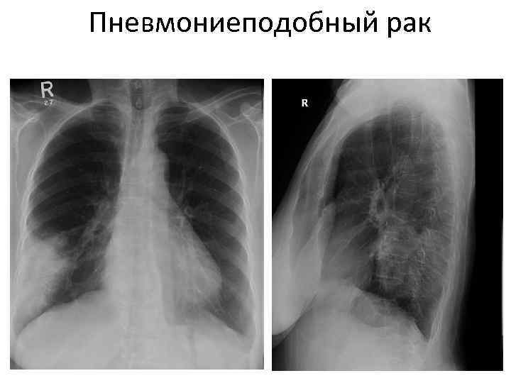 Как выглядит периферический рак легкого на компьютерной томографии