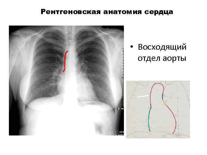 Рентгеновская анатомия сердца • Восходящий отдел аорты 