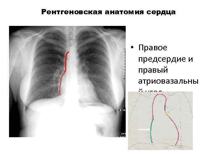 Рентгеновская анатомия сердца • Правое предсердие и правый атриовазальны й угол 