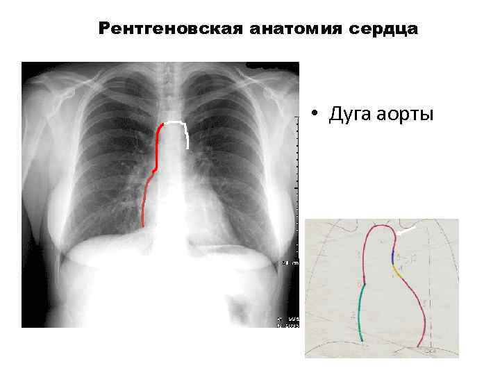 Рентгеновская анатомия сердца • Дуга аорты 