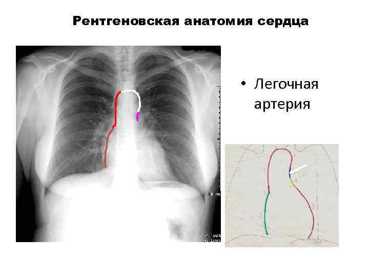 Рентгеновская анатомия сердца • Легочная артерия 