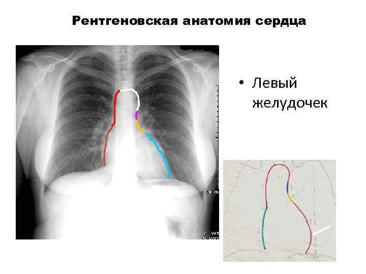 Рентгеновская анатомия сердца • Левый желудочек 