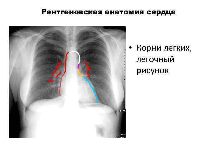 Рентгеновская анатомия сердца • Корни легких, легочный рисунок 