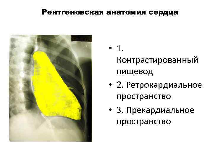 Рентгеновская анатомия сердца 1 1 2 3 3 5 7 • 1. Контрастированный пищевод