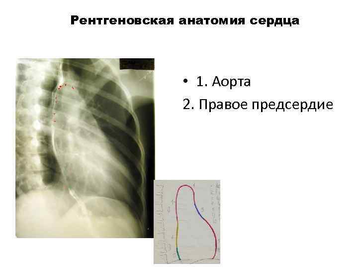 Рентгеновская анатомия сердца 1 • 1. Аорта 2. Правое предсердие 3 5 7 