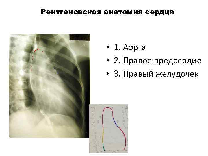 Рентгеновская анатомия сердца 1 • 1. Аорта • 2. Правое предсердие • 3. Правый