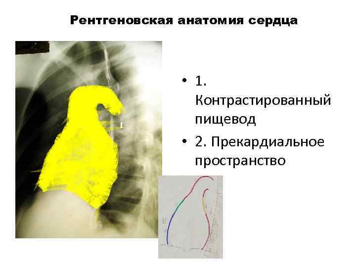 Рентгеновская анатомия сердца 11 4 1 2 5 7 • 1. Контрастированный пищевод •