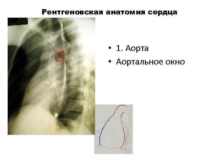 Рентгеновская анатомия сердца 1 • 1. Аорта • Аортальное окно 4 1 5 7