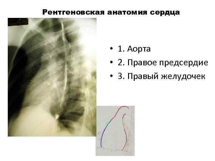 Рентгеновская анатомия сердца 1 • 1. Аорта • 2. Правое предсердие • 3. Правый