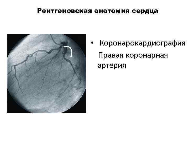 Рентгеновская анатомия сердца • Коронарокардиография Правая коронарная артерия 