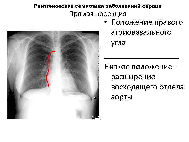 Рентгеновская семиотика заболеваний сердца Прямая проекция • Положение правого атриовазального угла _________ Низкое положение