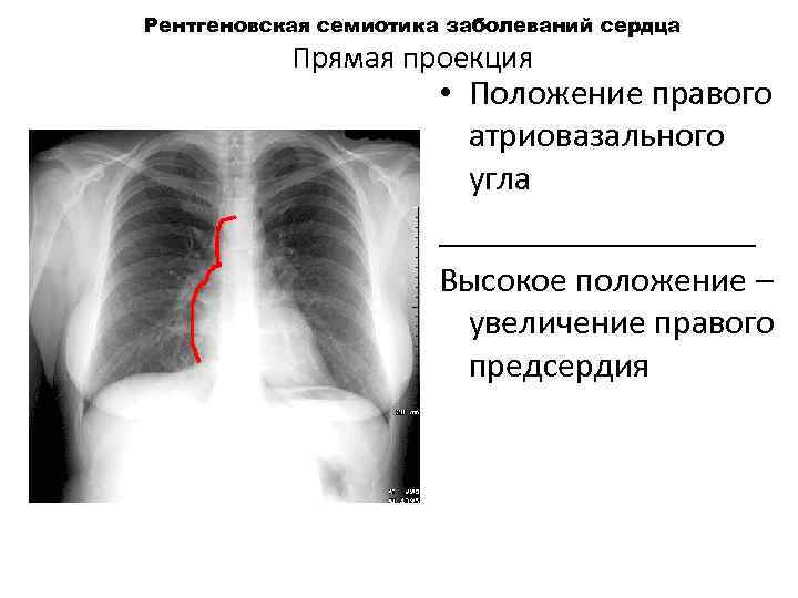 Рентгеновская семиотика заболеваний сердца Прямая проекция • Положение правого атриовазального угла _________ Высокое положение