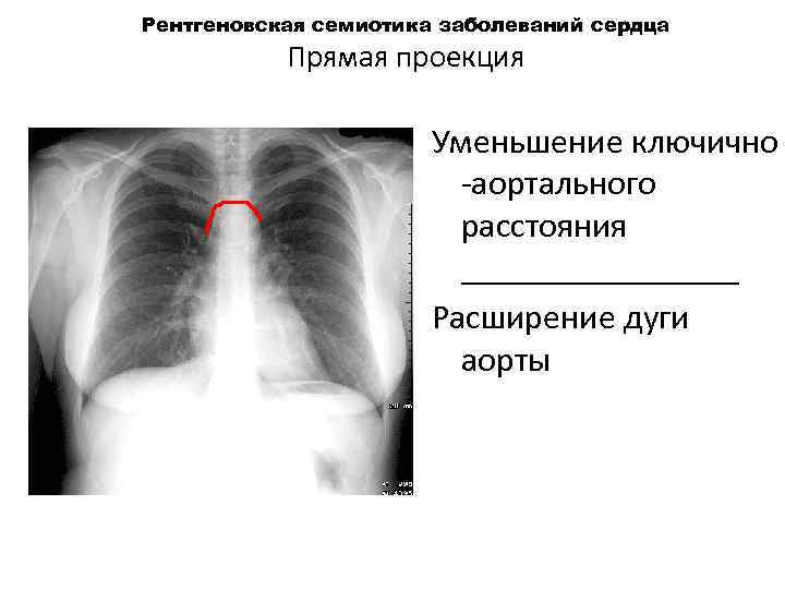 Рентгеновская семиотика заболеваний сердца Прямая проекция Уменьшение ключично аортального расстояния ________ Расширение дуги аорты