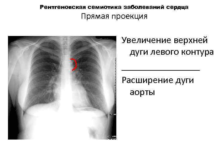 Рентгеновская семиотика заболеваний сердца Прямая проекция Увеличение верхней дуги левого контура ________ Расширение дуги