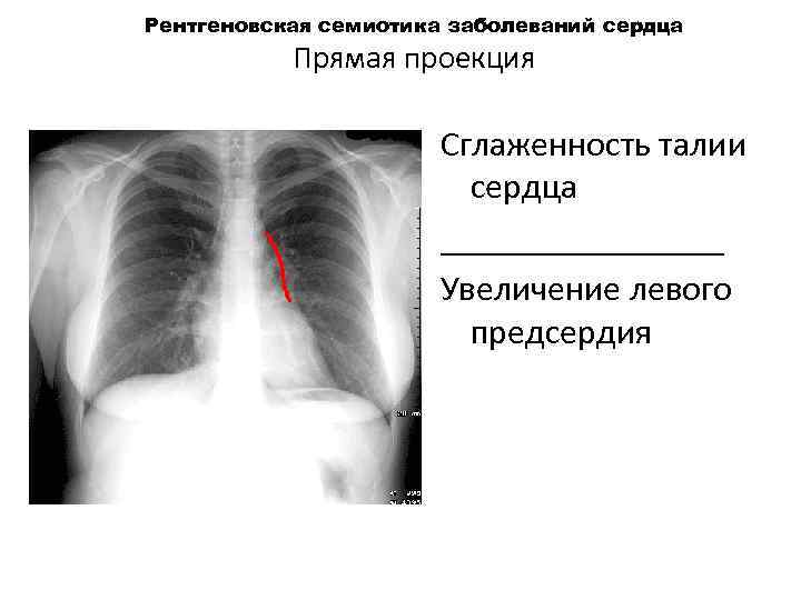 Рентгеновская семиотика заболеваний сердца Прямая проекция Сглаженность талии сердца ________ Увеличение левого предсердия 