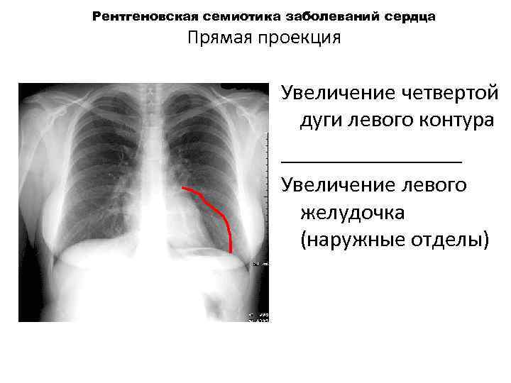 Рентгеновская семиотика заболеваний сердца Прямая проекция Увеличение четвертой дуги левого контура ________ Увеличение левого