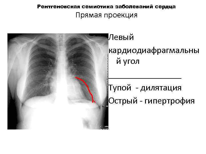 Рентгеновская семиотика заболеваний сердца Прямая проекция Левый кардиодиафрагмальны й угол ________ Тупой дилятация Острый