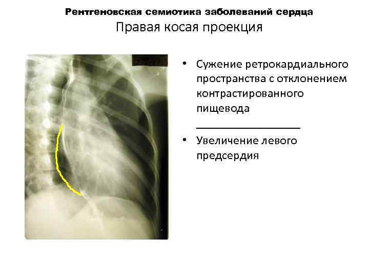 Рентгеновская семиотика заболеваний сердца Правая косая проекция • Сужение ретрокардиального пространства с отклонением контрастированного