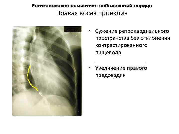 Рентгеновская семиотика заболеваний сердца Правая косая проекция • Сужение ретрокардиального пространства без отклонения контрастированного
