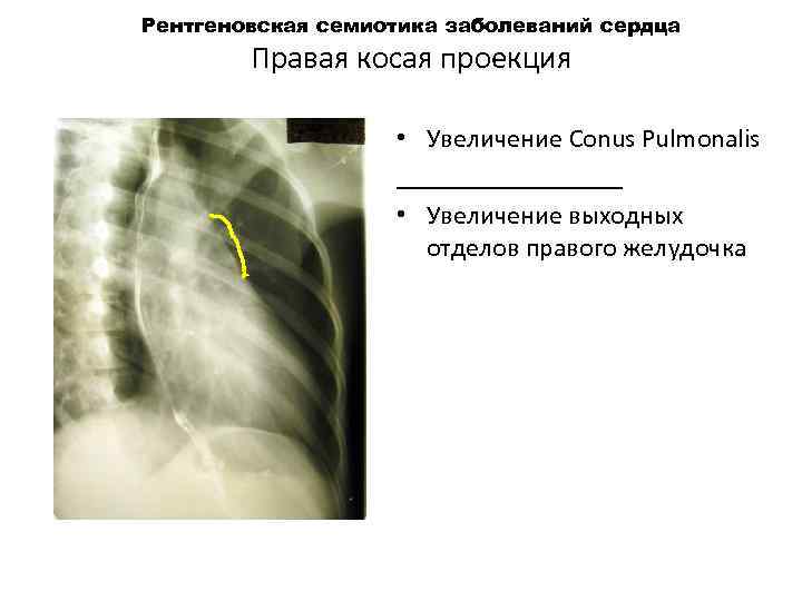 Рентгеновская семиотика заболеваний сердца Правая косая проекция • Увеличение Conus Pulmonalis _________ • Увеличение