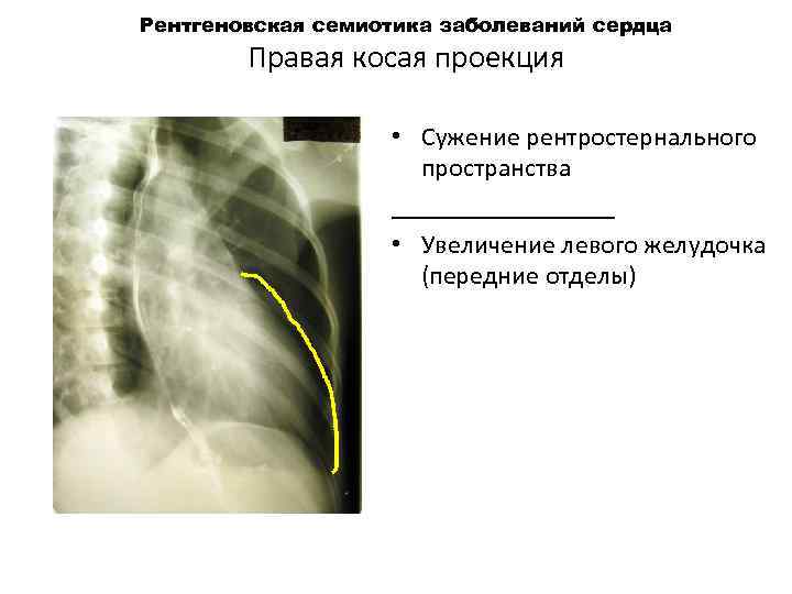 Рентгеновская семиотика заболеваний сердца Правая косая проекция • Сужение рентростернального пространства _________ • Увеличение