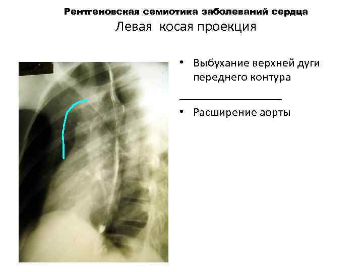 Рентгеновская семиотика заболеваний сердца Левая косая проекция • Выбухание верхней дуги переднего контура _________