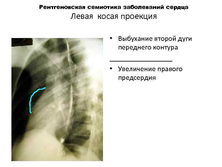 Рентгеновская семиотика заболеваний сердца Левая косая проекция • Выбухание второй дуги переднего контура _________