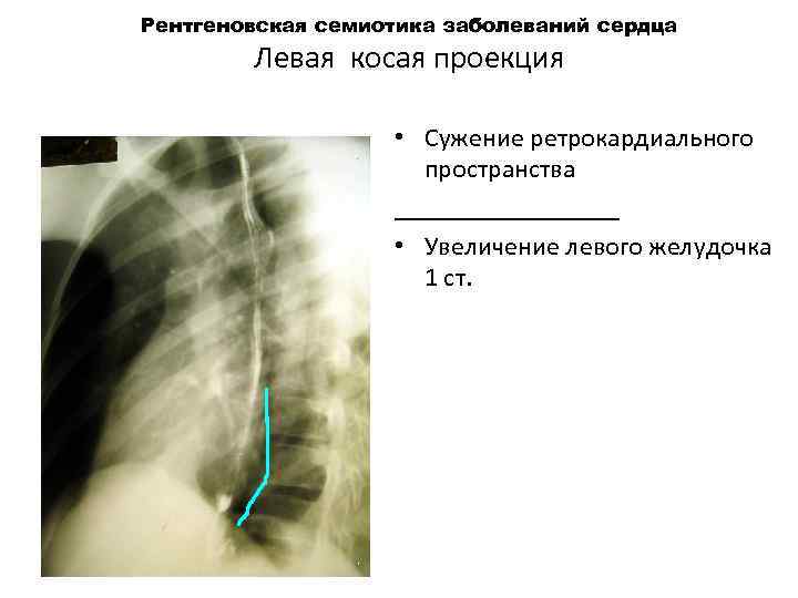 Рентгеновская семиотика заболеваний сердца Левая косая проекция • Сужение ретрокардиального пространства _________ • Увеличение