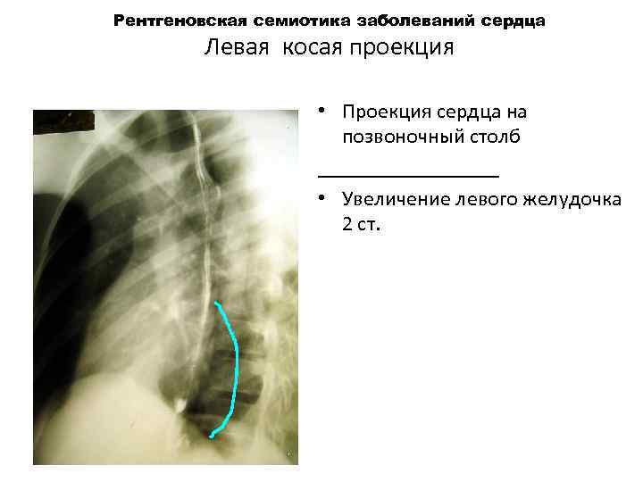 Рентгеновская семиотика заболеваний сердца Левая косая проекция • Проекция сердца на позвоночный столб _________