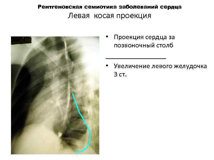 Рентгеновская семиотика заболеваний сердца Левая косая проекция • Проекция сердца за позвоночный столб _________