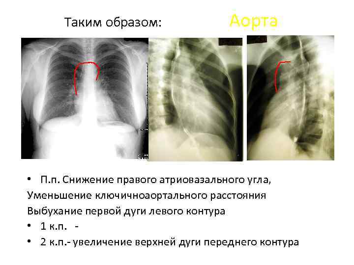 Таким образом: Аорта • П. п. Снижение правого атриовазального угла, Уменьшение ключичноаортального расстояния Выбухание