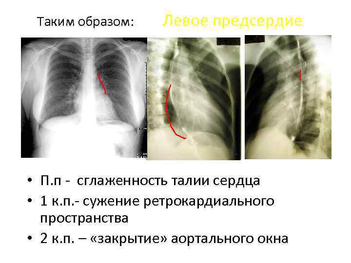 Таким образом: Левое предсердие • П. п сглаженность талии сердца • 1 к. п.