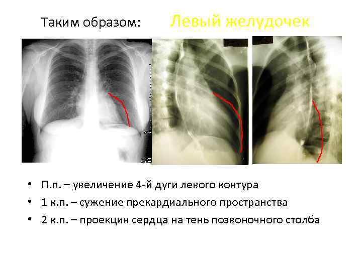 Таким образом: Левый желудочек • П. п. – увеличение 4 й дуги левого контура