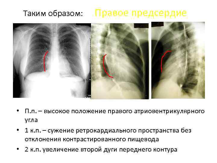 Таким образом: Правое предсердие • П. п. – высокое положение правого атриовентрикулярного угла •