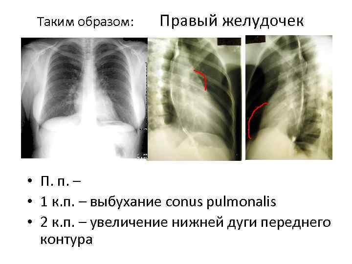 Таким образом: Правый желудочек • П. п. – • 1 к. п. – выбухание