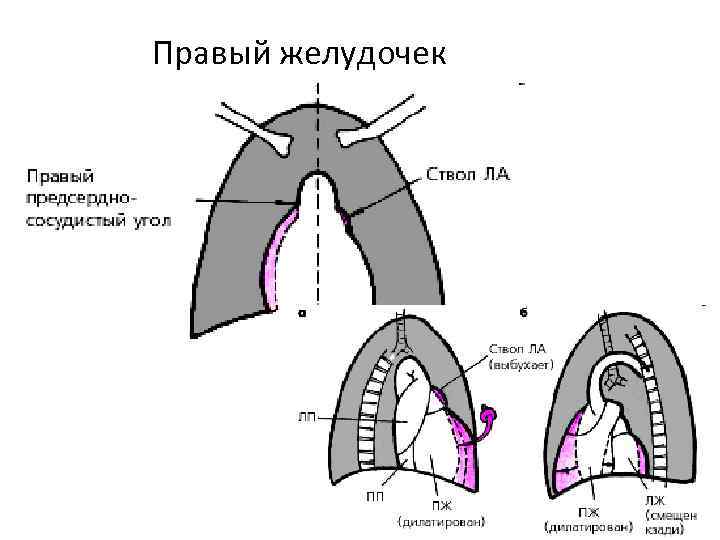 Правый желудочек 